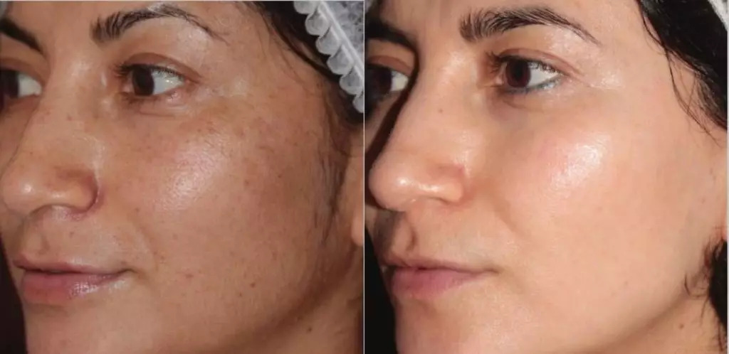 BBL laser skin treatment