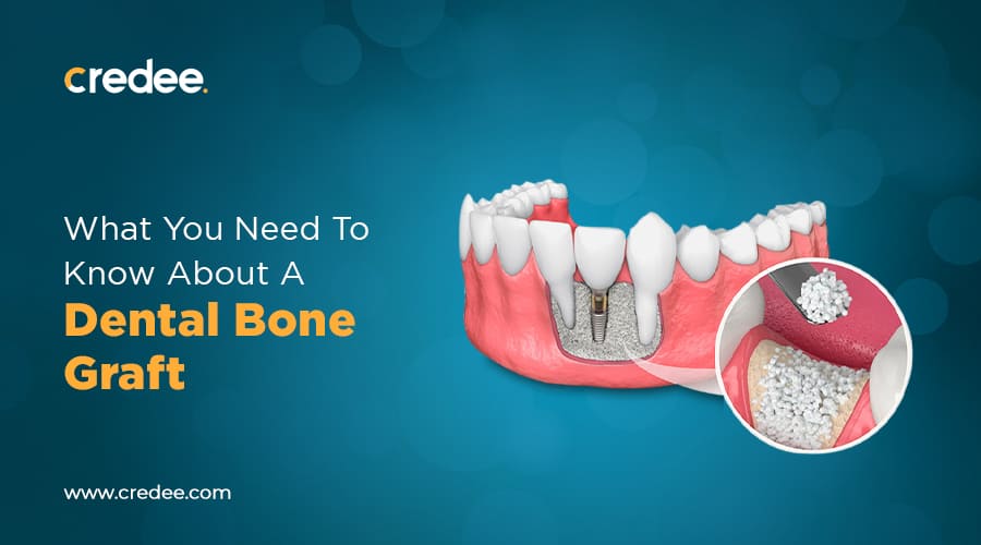 Dental Bone Graft