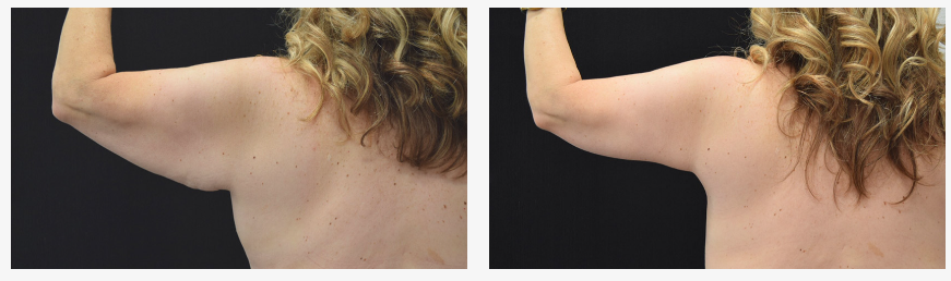 Before and After Images of Brachioplasty