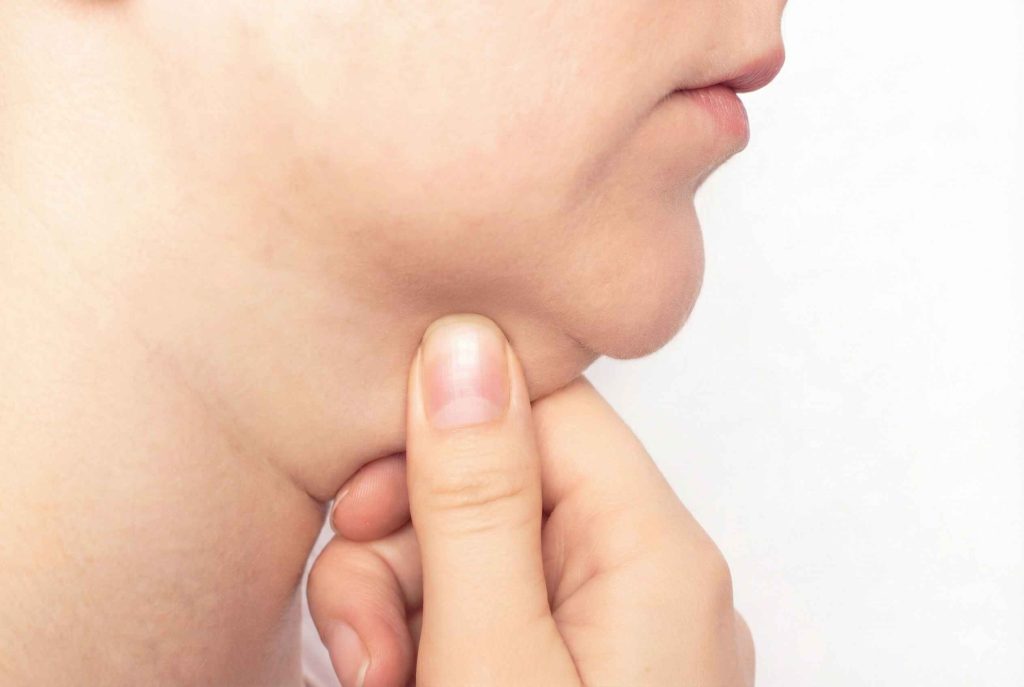 Before the Kybella Procedure