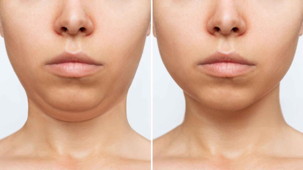 After the Kybella Procedure