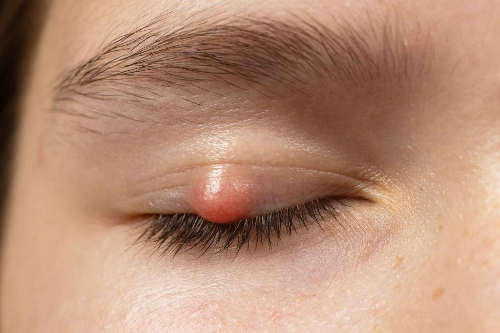 Early Chalazion as a Small white Bump on Eyelid
