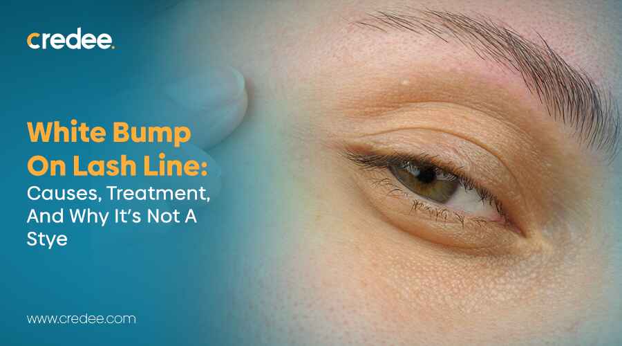 White Bump on Lash Line